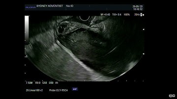 EUS Guided Gallbladder Drainage: Hot Axios Lams Insertion