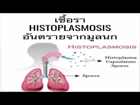 โรคฮิสโตพลาสโมซิส Histoplasmosis อีกโรคหนึ่งซึ่งเกิดจากการหายใจเอาสปอร์ของเชื้อราจากมูลนก