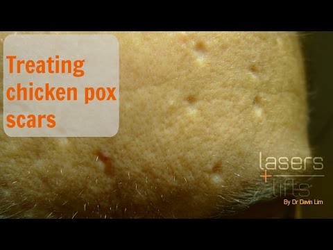 Video: Scars After Chickenpox: How To Remove On The Face And Body, Photo