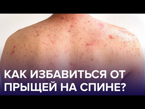 Видео: Може ли никотинът да причини акне?