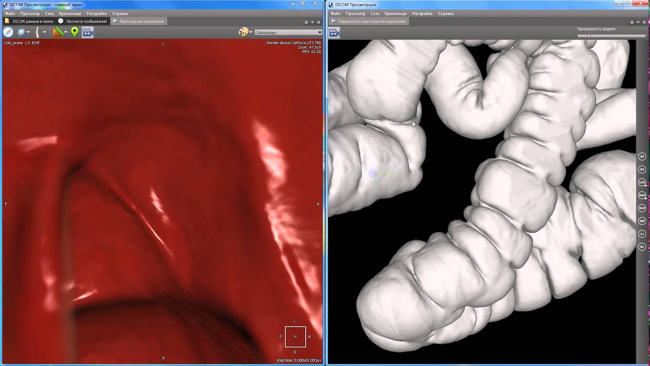 Virtual colonoscopy. Camera flight.
