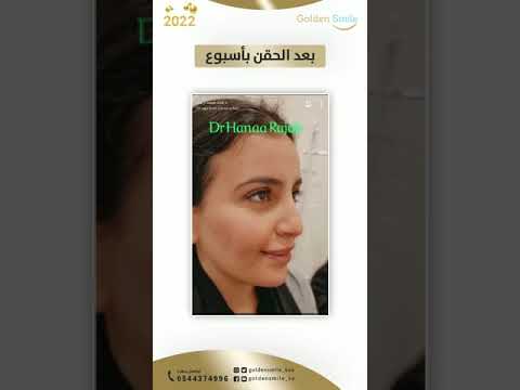 حقن الفيلر لتحديد الوجه تغنيك عن عمليات التجميل