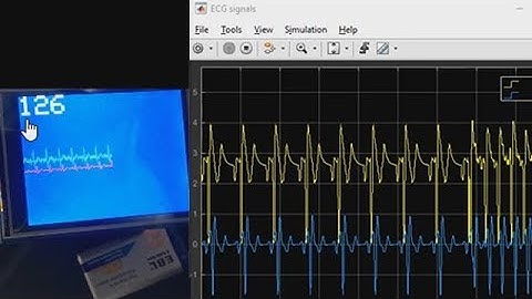 How to Build a Heart Rate Detector Using Arduino and MATLAB