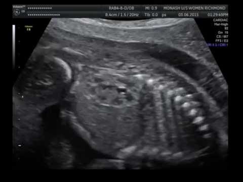normal fetal kidneys youtube