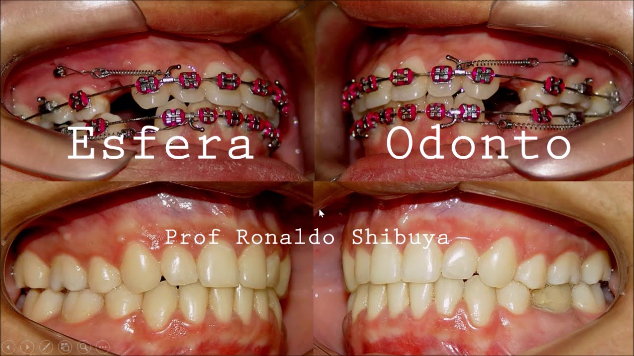 RETRAÇÃO ANTERIOR PARTE 1