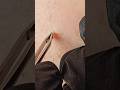 Tweezing Ingrown Hairs Early Inflamed | Satisfying STA ASMR