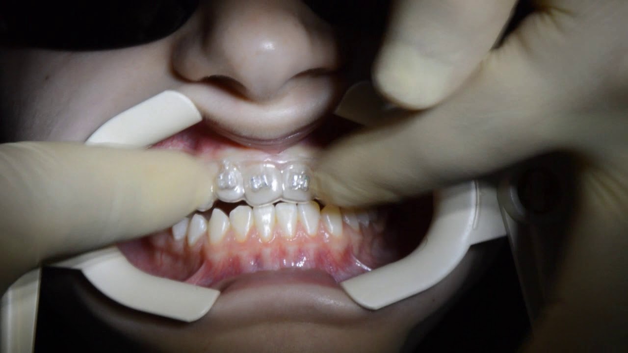 Indirect Digital Bonding System “Easy Brace” YouTube