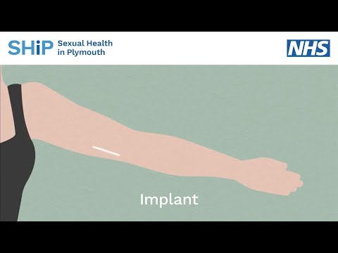 Video: Sunt sigure implanturile de natrele?