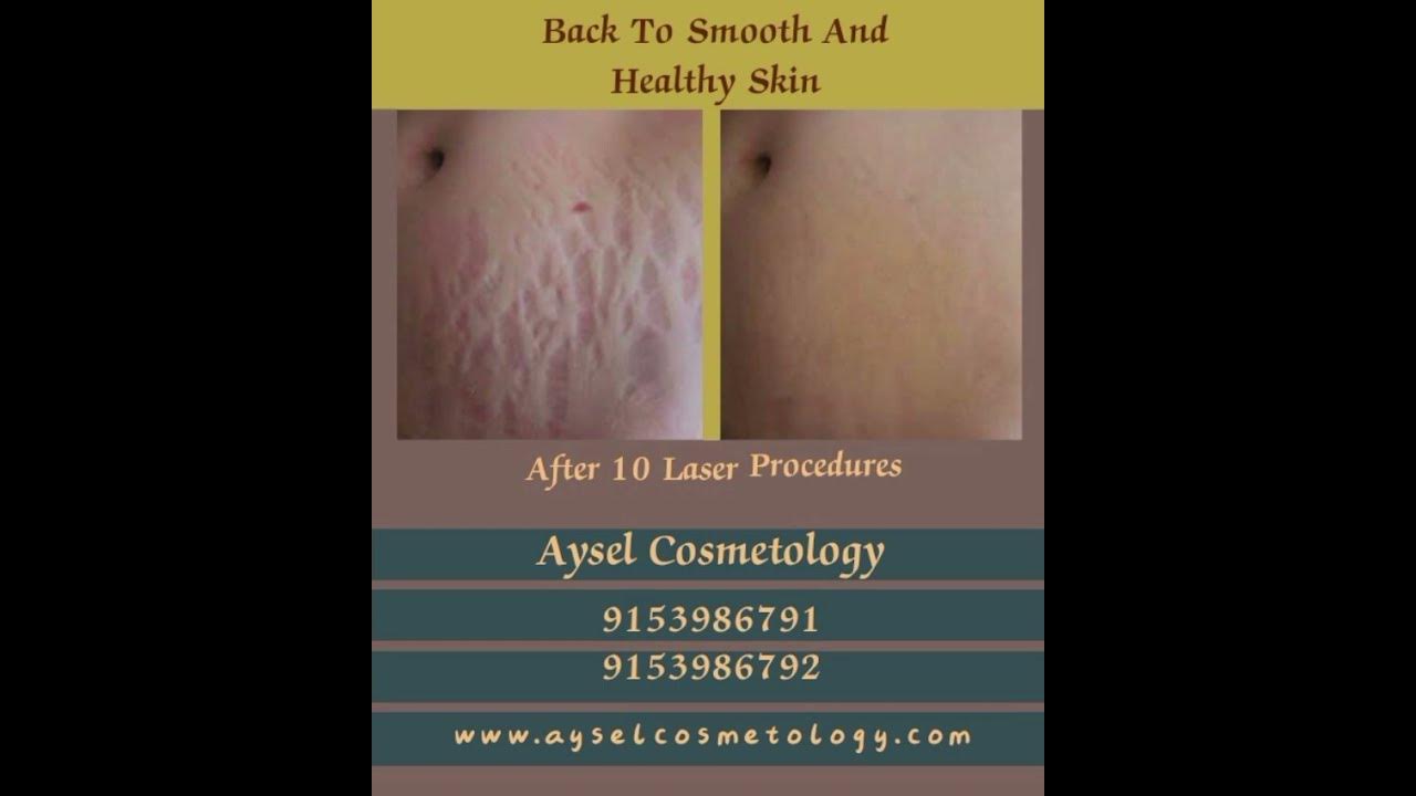 laser-stretch-marks-removal-youtube