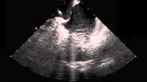 Hands-On Ablation - Video 12.13