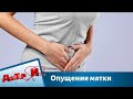 Опущение матки: причины, симптомы, лечение | Доктор И