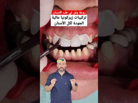 فيديو: هل تركيبات القرش تدوم؟