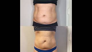 Cryoskin Body Contouring at Huemn