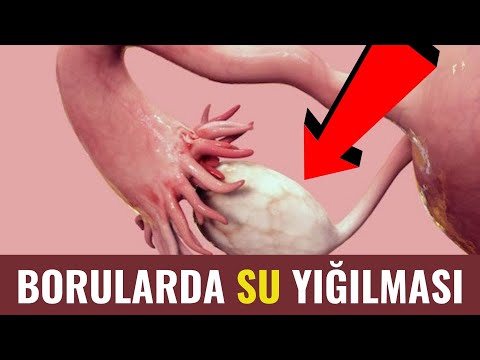 Video: Hamiləliyin Müvəffəqiyyətsiz Servikslə uzadılmasının 3 yolu