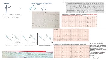 STEMI part 2- Questions and case scenarios- Elias Hanna