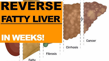 The FASTEST Way to Reverse Fatty Liver, Naturally | NAFLD Treatment