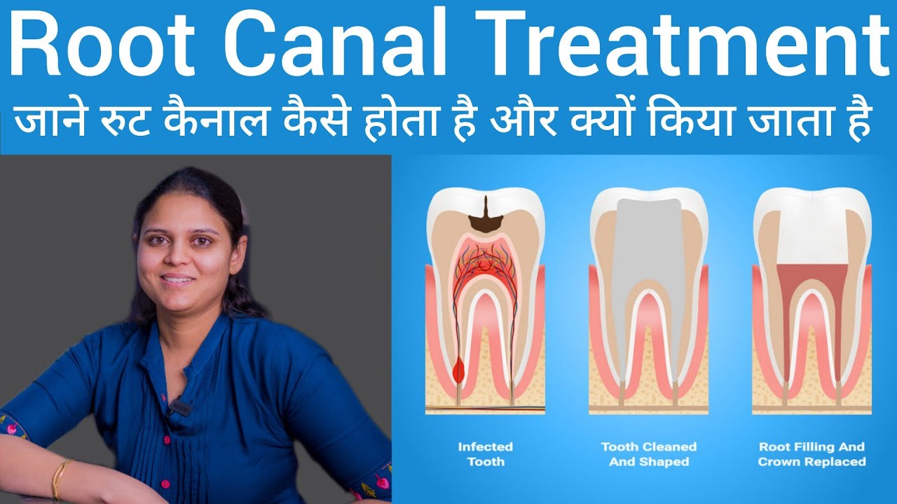 Root Canal Treatment दांतो को कब पड़ती है रूट कैनाल ट्रीटमेंट की जरूरत