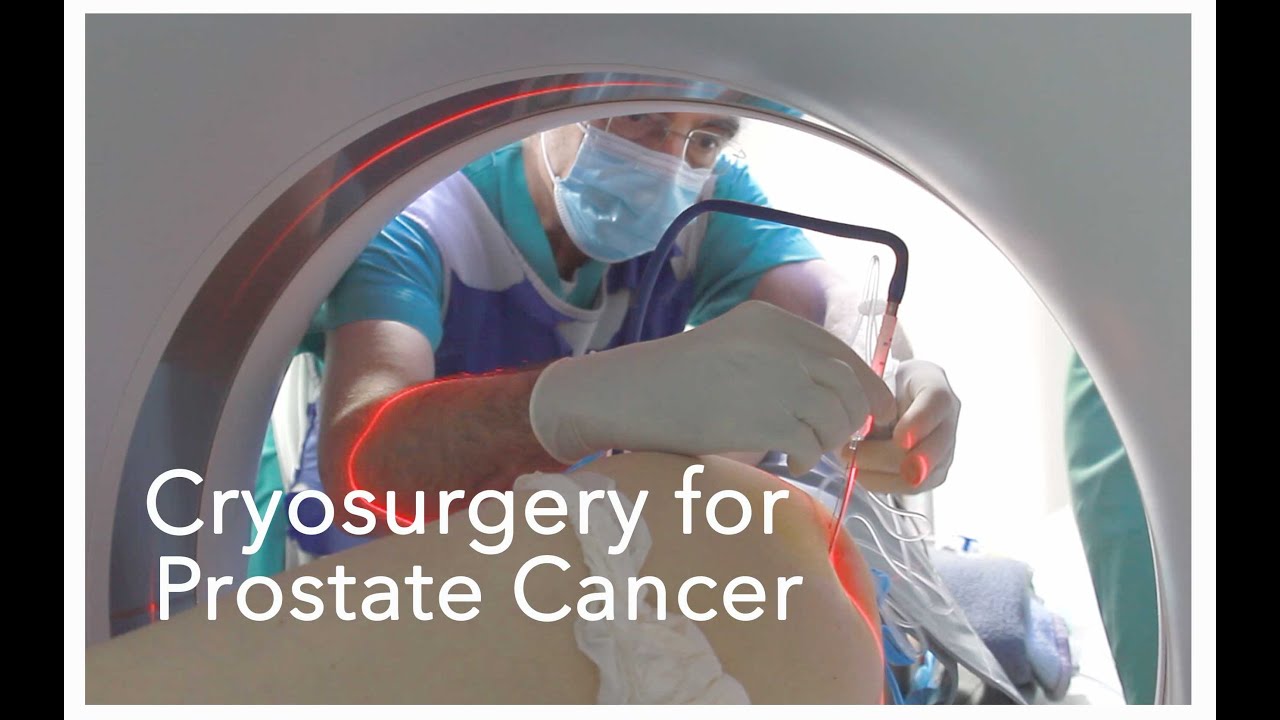 Cryosurgery for prostate cancer YouTube