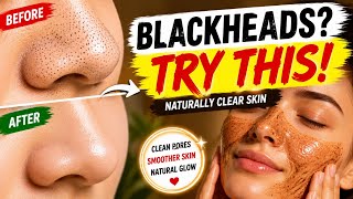 Remove Blackheads Naturally at Home | Honey & Cinnamon Face Mask for Clear Skin