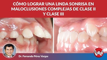 Cómo lograr una linda sonrisa en maloclusiones complejas de clase II y clase III