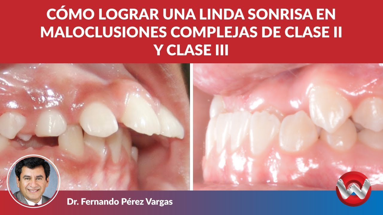 Cómo lograr una linda sonrisa en maloclusiones complejas de clase II y clase III