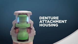Introducing ZEST LOCATOR F TX Fixed Attachment System   Animation