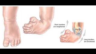 Talipes equinovarus and Metatarsus Adductus; deformity where the foot is twisted inward and downward