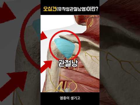 오십견(유착성 관절낭염)이란?