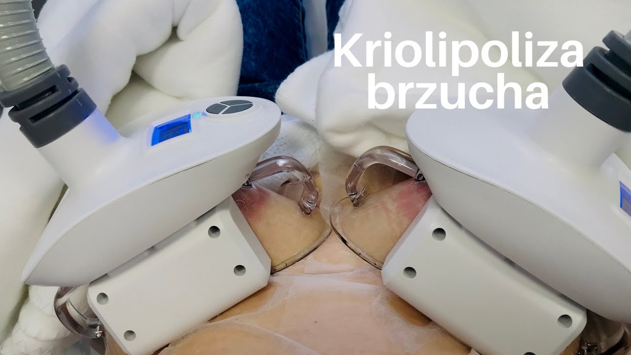 KRIOLIPOLIZA  📢JAK WYGLĄDA ZABIEG?📢 KROK PO KROKU