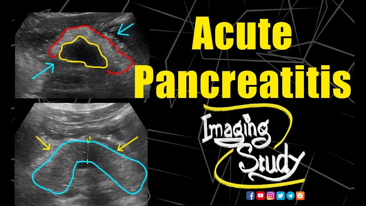 pancreas ultrasound