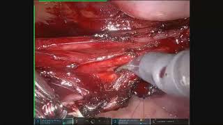 Bladder Endometriosis Ureteral ICG