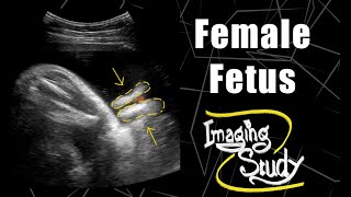 Female Fetus - Its a Girl || Ultrasound || Case 58