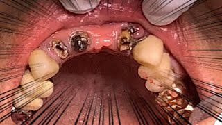 歯を外しました（歯医者のブリッジ治療をすべてお見せします）