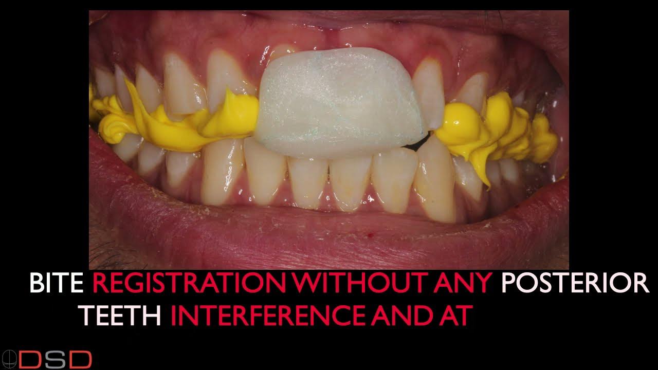 Cosmetic Dentistry / Occlusal Equilibration Part 1 Of 4 Series Video