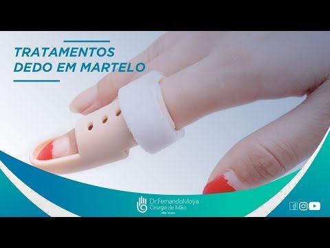 Dedo em Martelo: tratamentos | Dr. Fernando Moya CRM 112.046