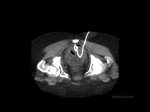 Percutaneous CT-guided drainage of a pelvic collection