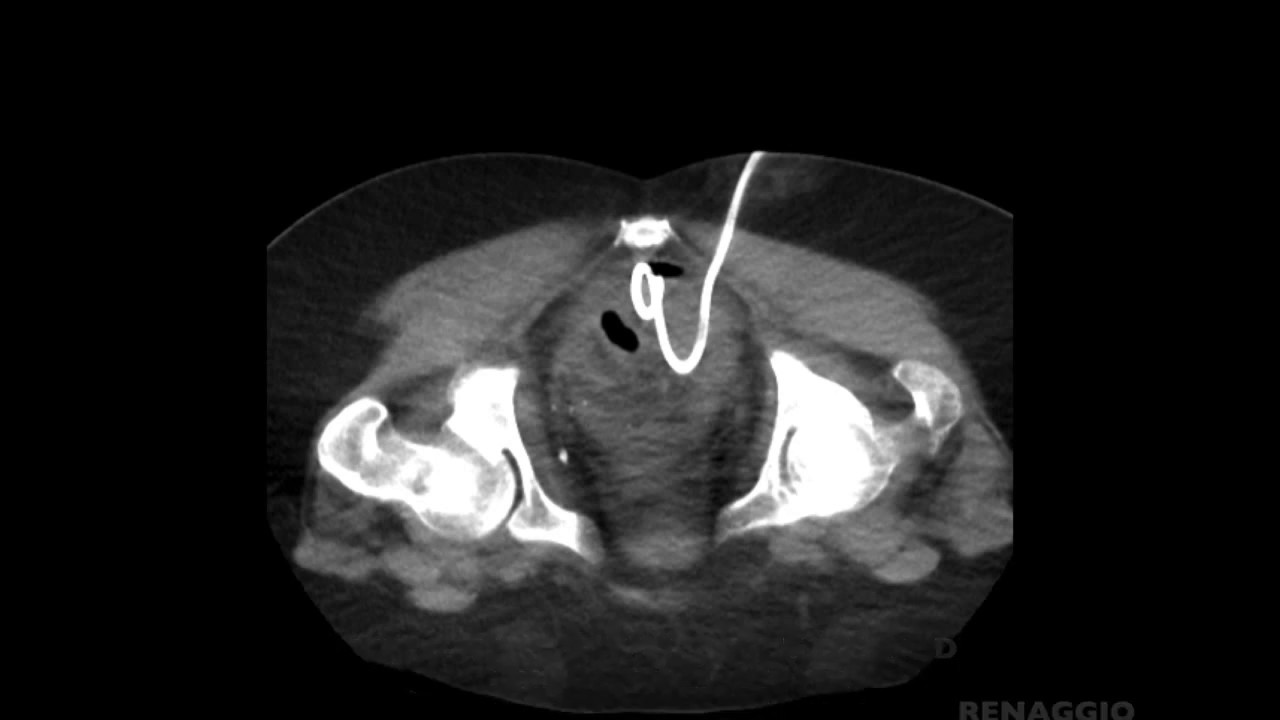 Percutaneous CTguided drainage of a pelvic collection YouTube