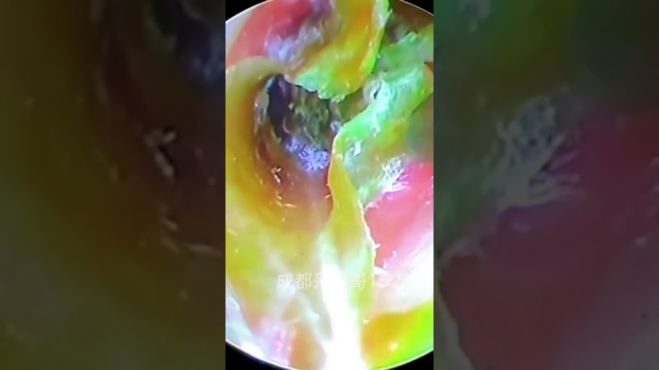 Satisfying Video Ear Wax Removal how to remove ear wax by endoscopic