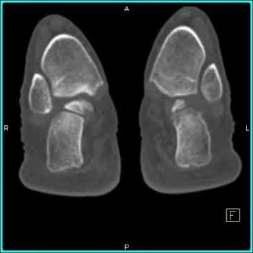 64 MDCT:  DJD of ankle with .6 mm thin sections (1 of 2)