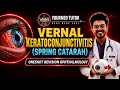 VERNAL KERATOCONJUNCTIVITIS (VKC) | SPRING CATARAH | OPHTHALMOLOGY #ophthalmology #conjunctivitis