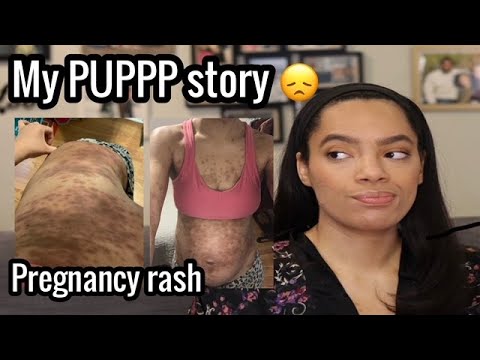 INTENSE PREGNANCY RASH | PUPPP rash during pregnancy | My story & experience with PUPPS