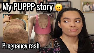 INTENSE PREGNANCY RASH | PUPPP rash during pregnancy | My story & experience with PUPPS