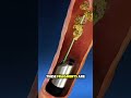 Laser Kidney Stone Removal (3D) #3dmedicalanimation #kidneystone #kidneystoneremoval #kidneysurgery