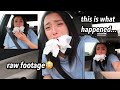 I GOT MY WISDOM TEETH REMOVED & THIS IS HOW IT WENT... | raw footage, updates & more