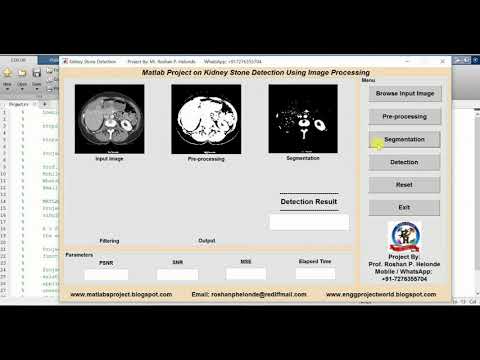 Kidney Stone Detection Using Image Processing Matlab Source Code Kidney Stone Analysis Using Matlab