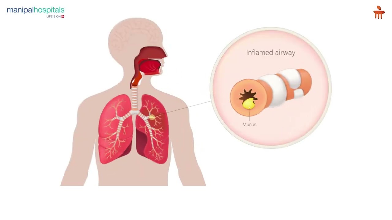 Asthma - Symptoms and Management | Dr. Benin Rajesh R. A. | MMH