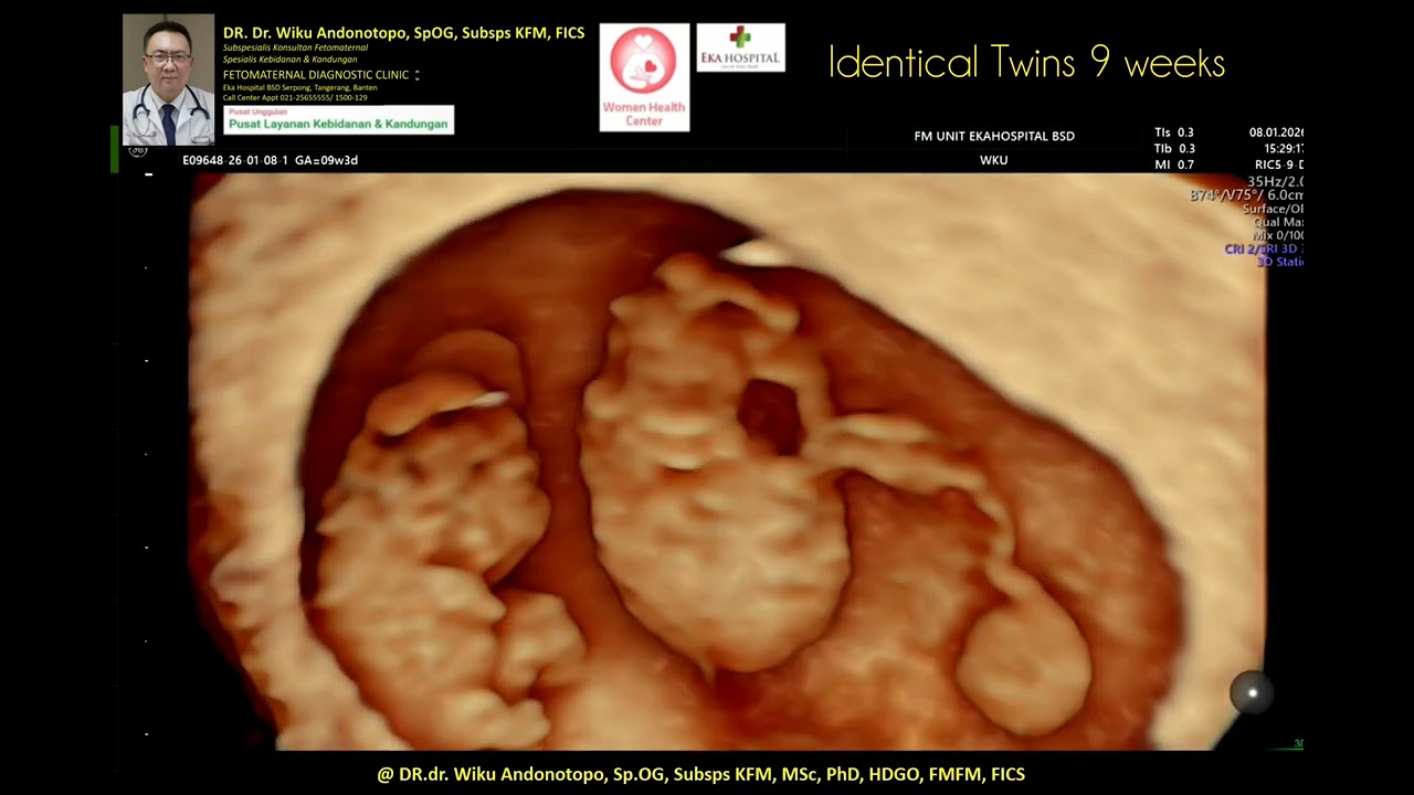 9 weeks Identical Twins