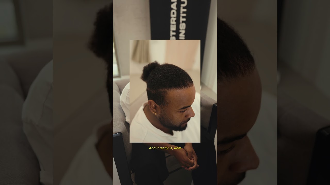 Cliëntervaring: Bruno over zijn FUE CT haartransplantatie (kroeshaar)