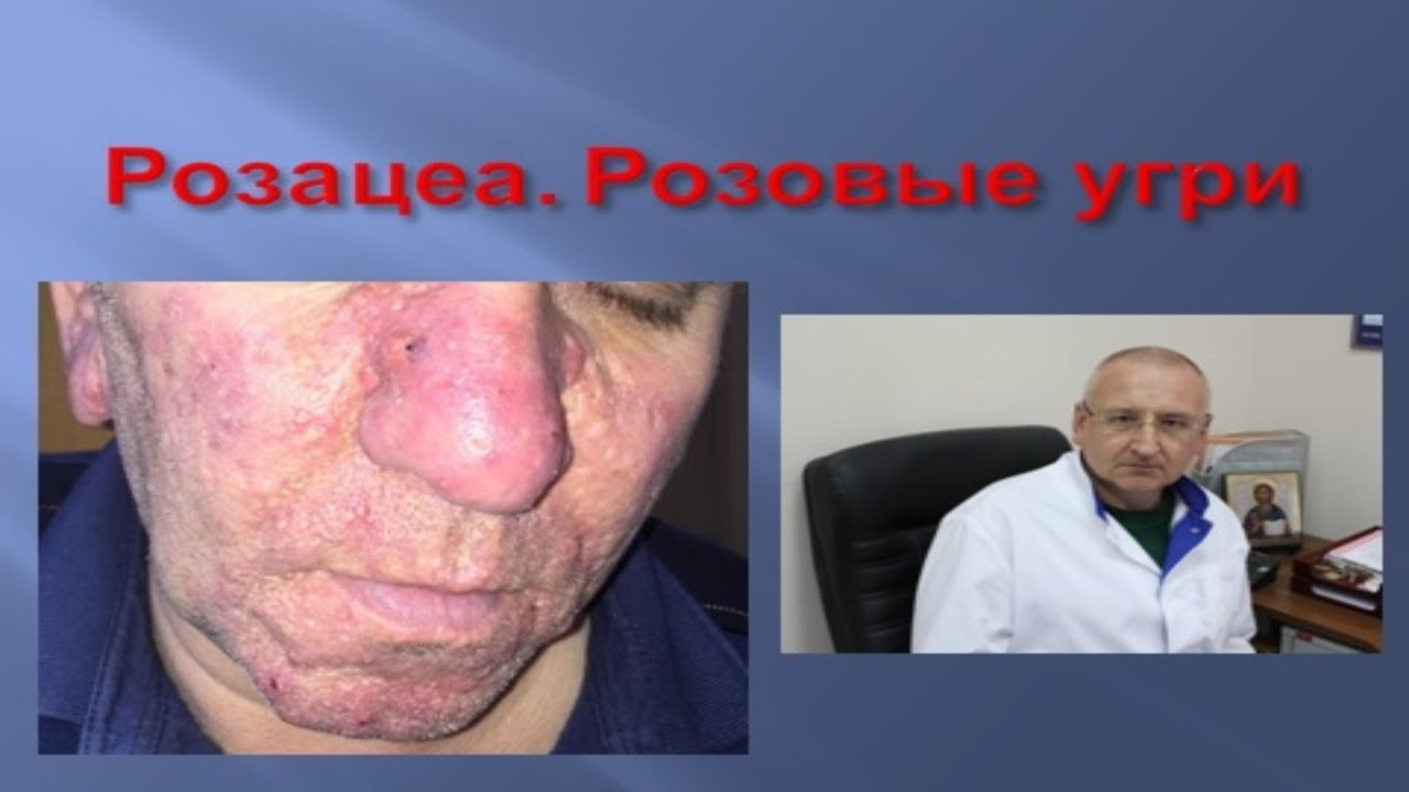 Розацеа. Розовые угри.