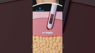 Brazilian Butt Lift (BBL): How the procedure works? 🔬